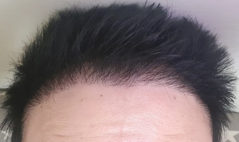 모발이식 2차수술이후 현재 모습입니다....전 실패라 봅니다 ㅠㅠ 1차때이후도 2차 이후도 흑채없음 슈퍼도 못가겠어요.