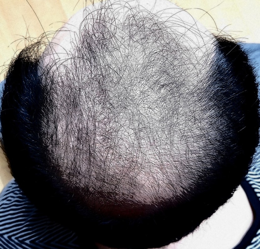 3개월 경과후 3월 30일 사진입니다