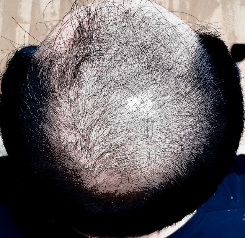 4개월 경과후 4월 20일 사진입니다