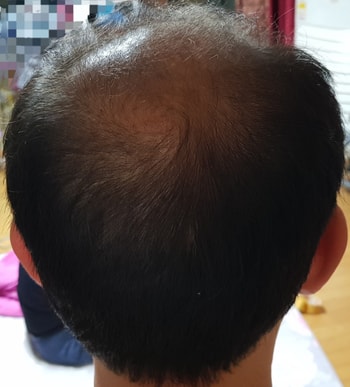 뒷머리 사진입니다. 어제...