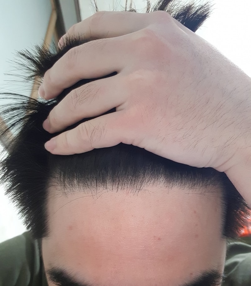 hair loss nutritional supplements