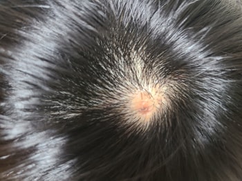 절개술 후 주변 모발탈락