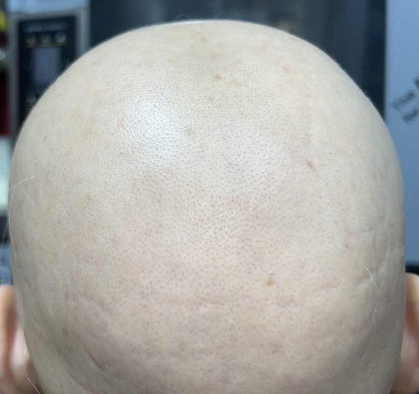 올루 복용직전의 모습이고