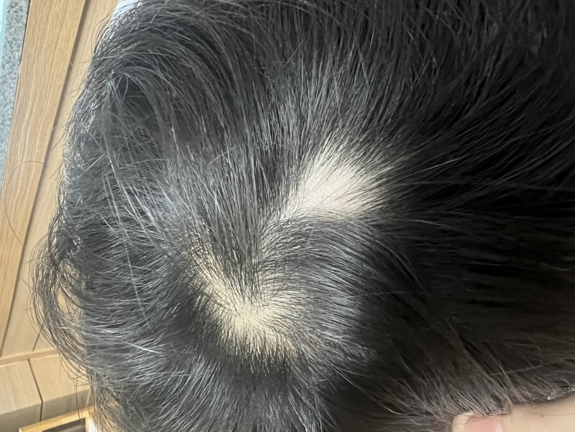 한달 반 전에 원형탈모 처음 발견했을때 사진입니다 100원짜리보다 작았어요