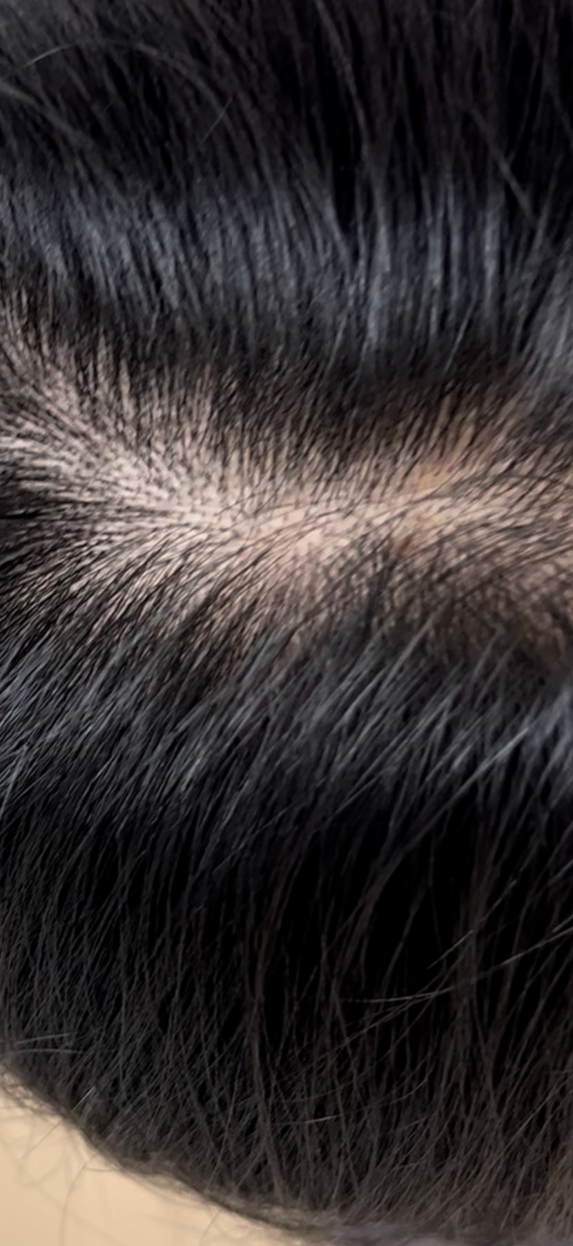 로게인폼 1주차