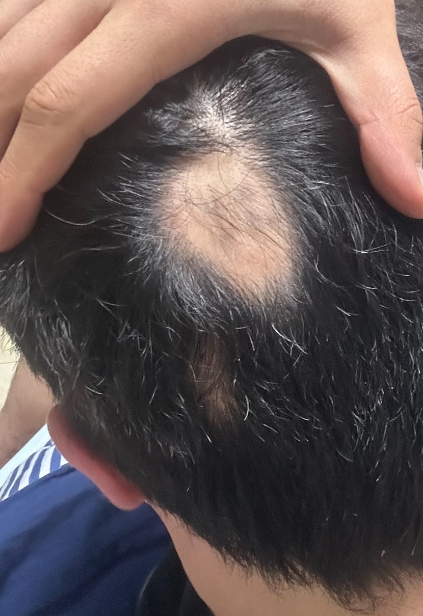 최초 발생(주사 5회)