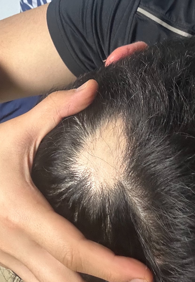 최근 추가 발생(주사 2회)