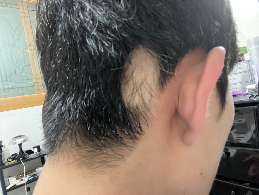 2주 뒤 엄청 커지고 1x1크기에 원형탈모가 8개 더 생김