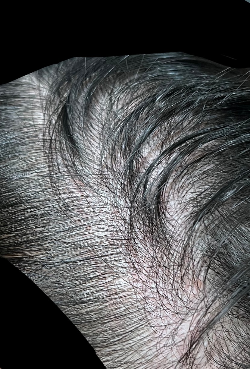 오른쪽 측두부2