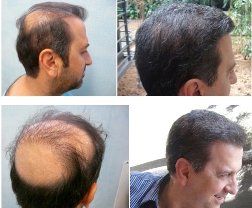 14,000 Grafts Using Body Hair Transplant – 11 Month Update