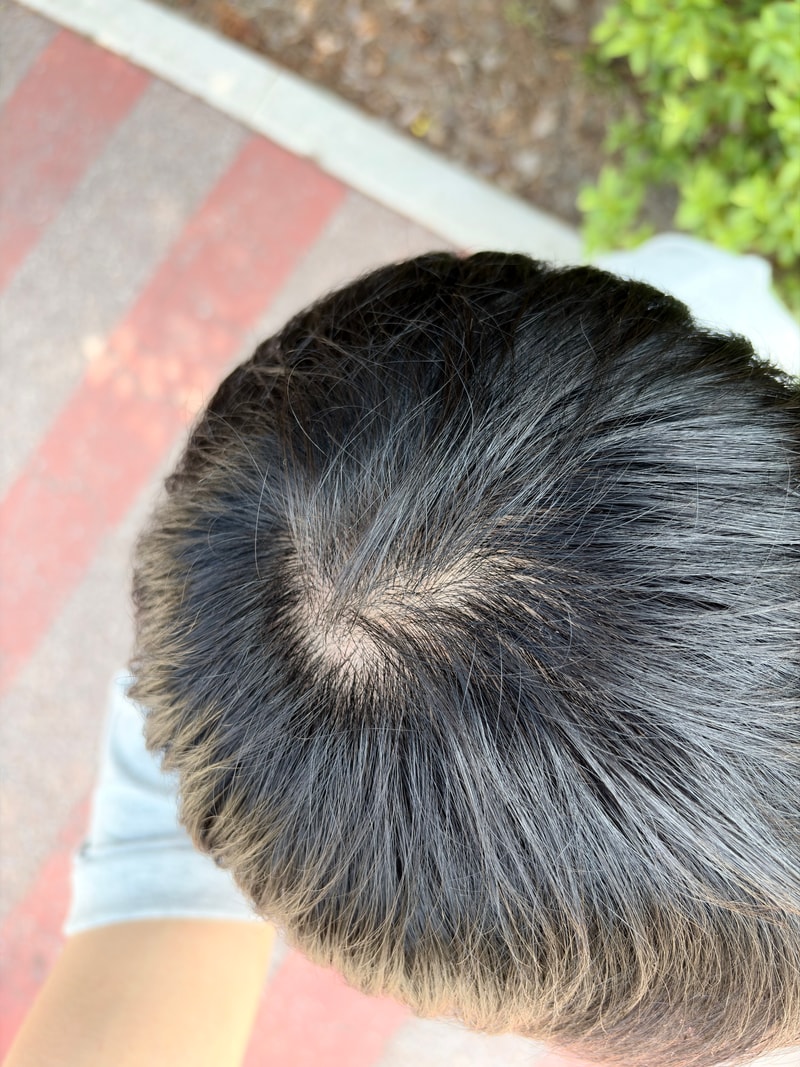 脱发药品