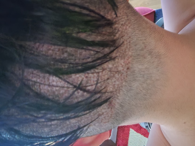 후두부상태 마데카솔 괜찮나요?