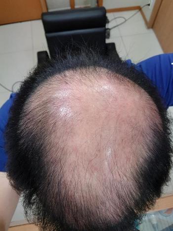 37일전 치료전 사진