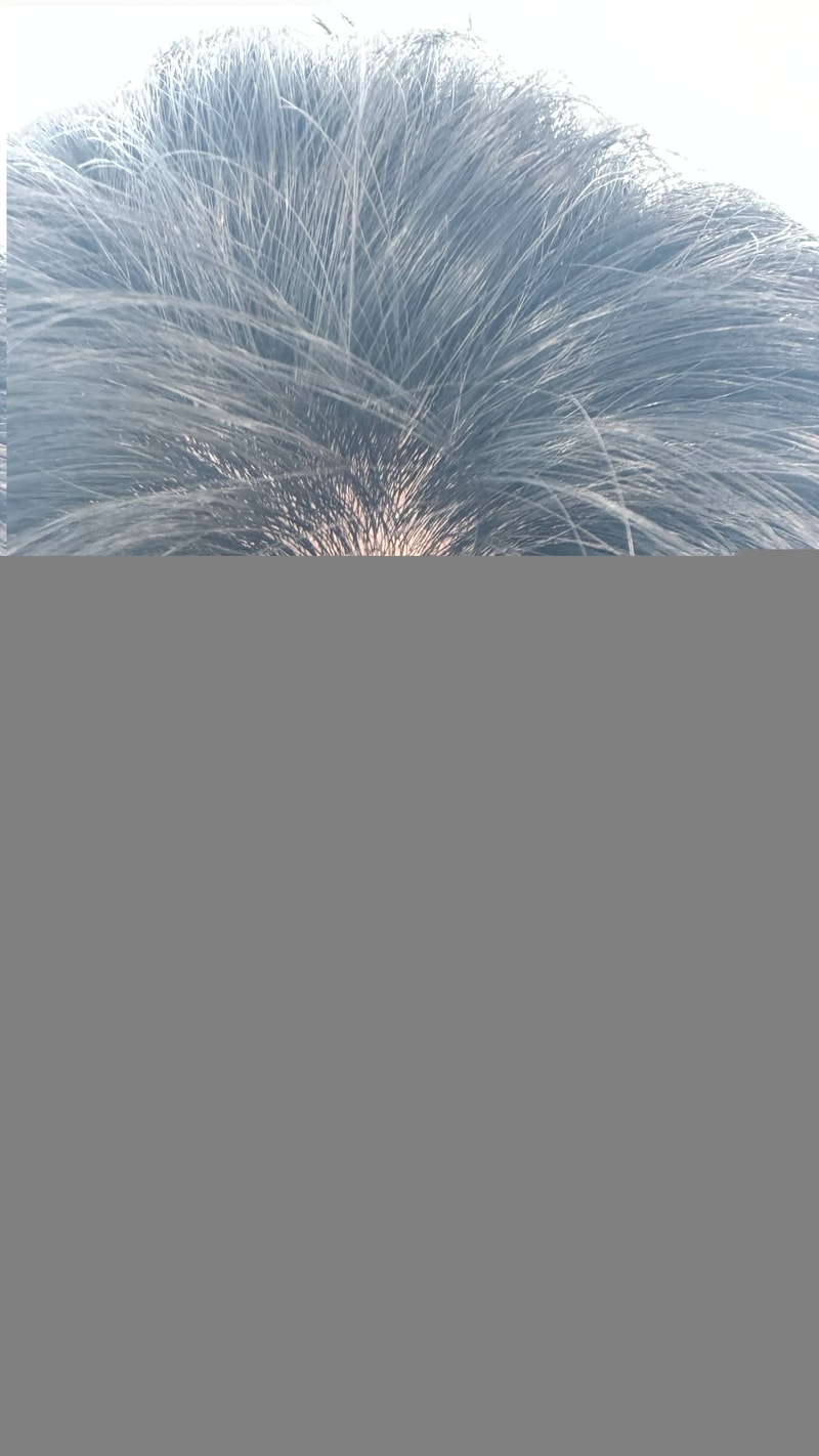 피나온 6개월정도 복용 후기입니다.