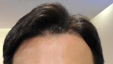 아보다트 복용 후 (2023년)