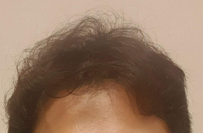 아보다트 복용 전 (2019년)