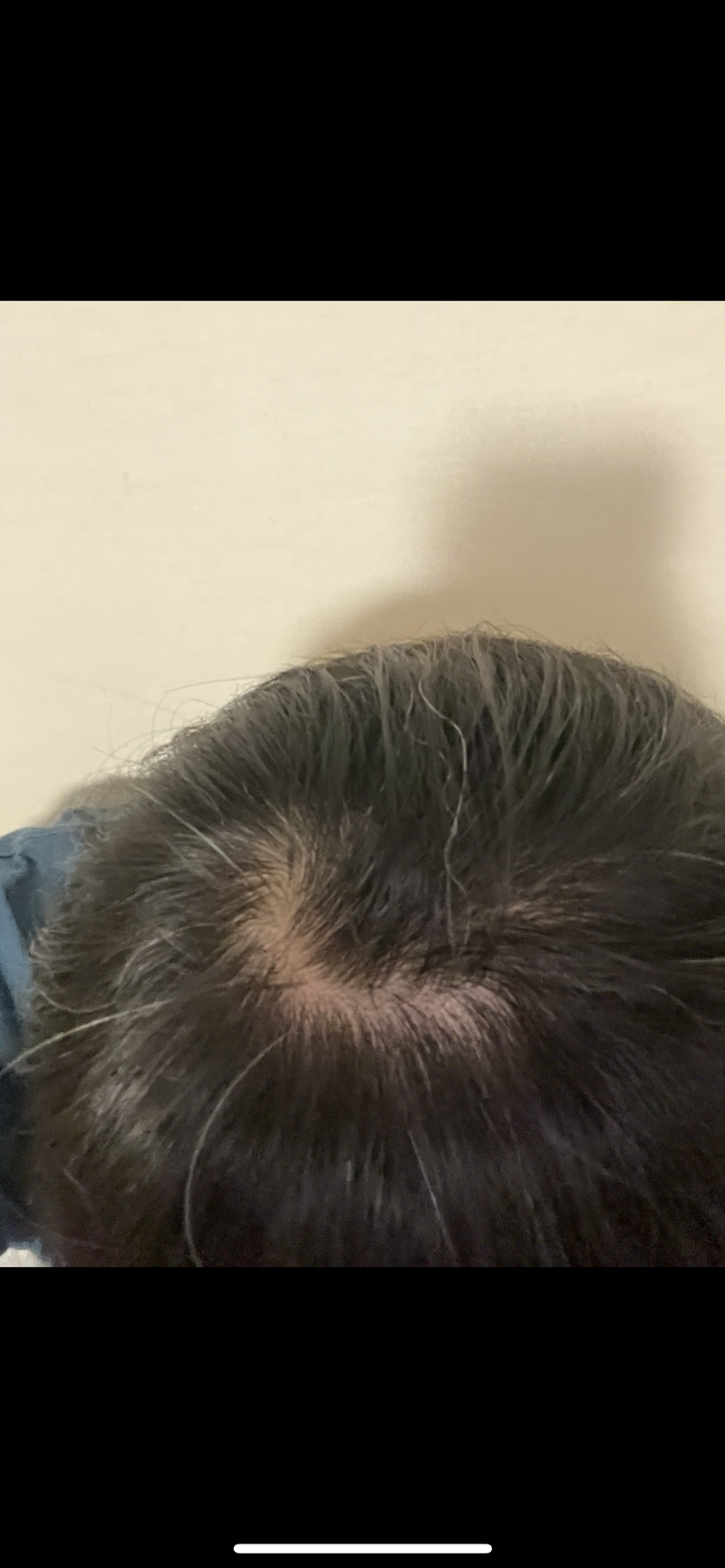 미녹시딜 정수리 도포 한달 정도 됐습니다