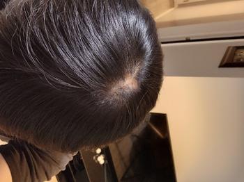 22년 9월 약먹기 시작했을 때
