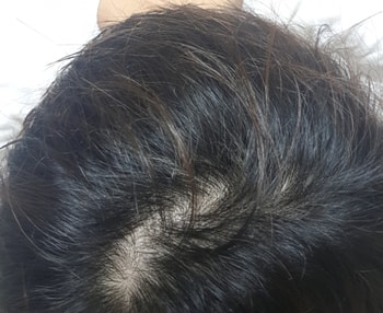 작년 8월 사진이에요. 약을 살 여유가 안되고 공부하느라 3개월 정도 먹다가 8월부터 안먹기 시작했었네요                                                                     
