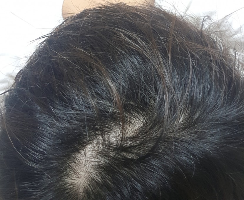 작년 8월 사진이에요. 약을 살 여유가 안되고 공부하느라 3개월 정도 먹다가 8월부터 안먹기 시작했었네요                                                                     