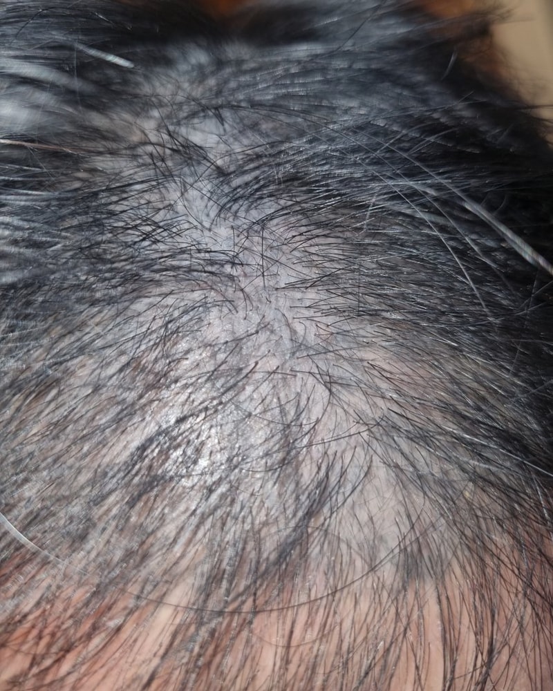 피나+미녹정+비오틴 복용 70일째