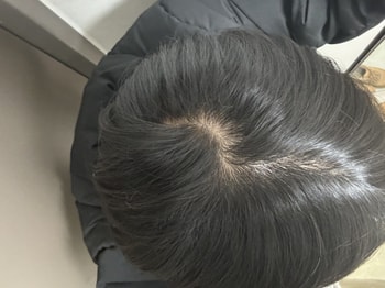 피나 복용 전