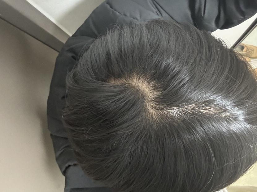 피나 복용 전