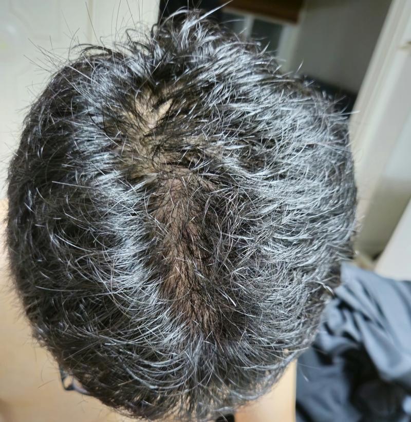정수리 탈모 진단받고 피나스테리드 복용