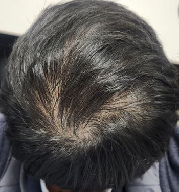 미녹시딜정 시작 후