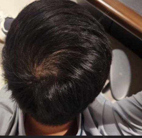 미녹시딜정 시작 전