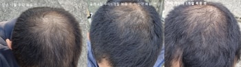 조합처방약 복용 1개월 후기