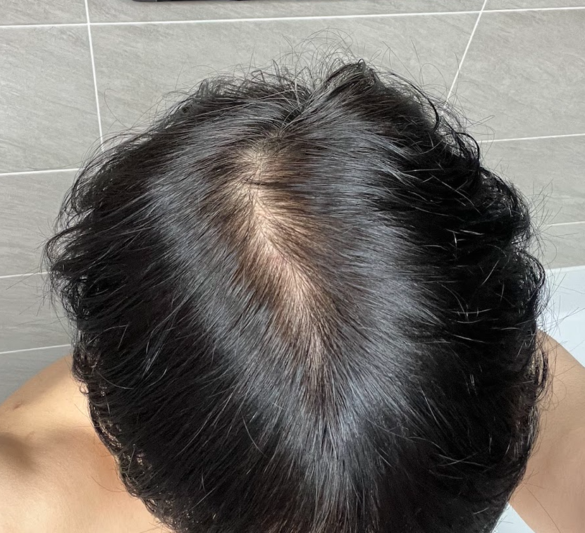 오랜만에 두피 사진찍고 심각함을 느낌..