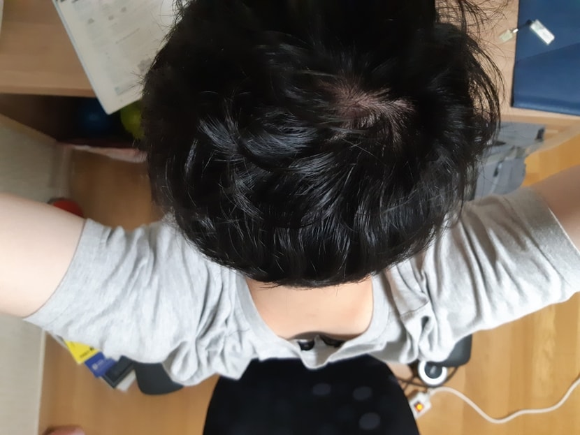 탈모 가능성 있나요 이것 때문에 요즘 많은 고민이 있어요