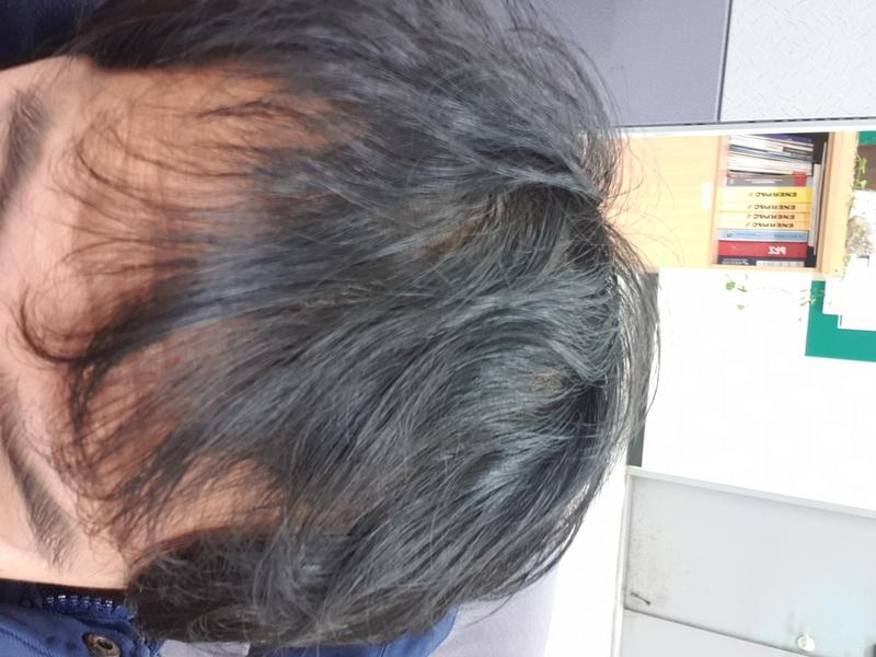 프로페시아 5년 후기