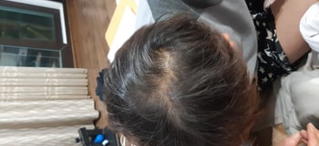 복용전 사진