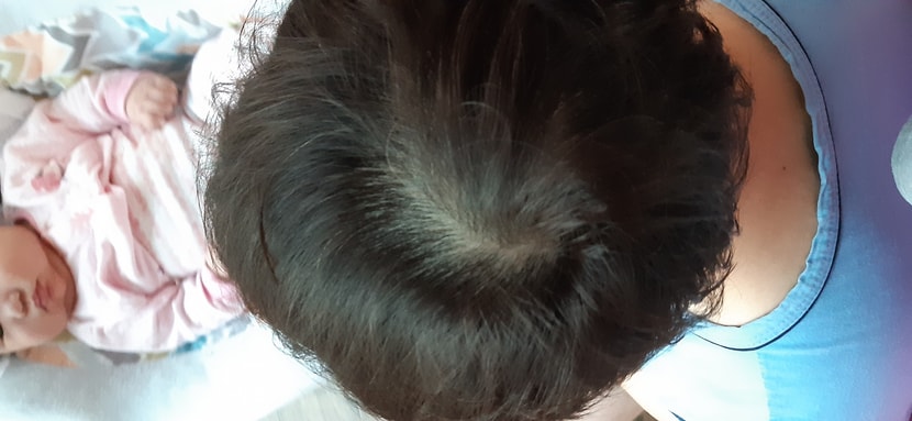 복용후 사진