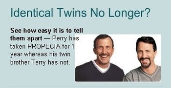 1년동안 피나스테리드를 복용한 쌍둥이와 아닌 다른 쌍둥이