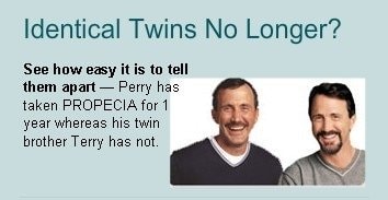 1년동안 피나스테리드를 복용한 쌍둥이와 아닌 다른 쌍둥이