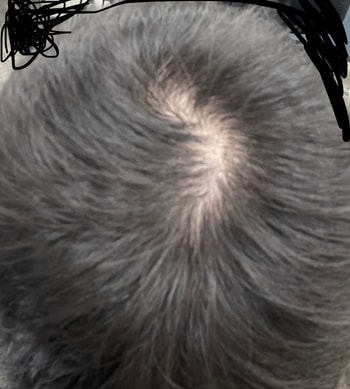 복용 3개월 차 사진입니다.