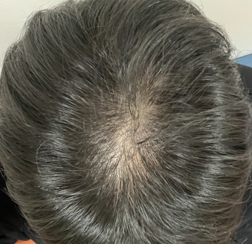탈모 진단받기 전