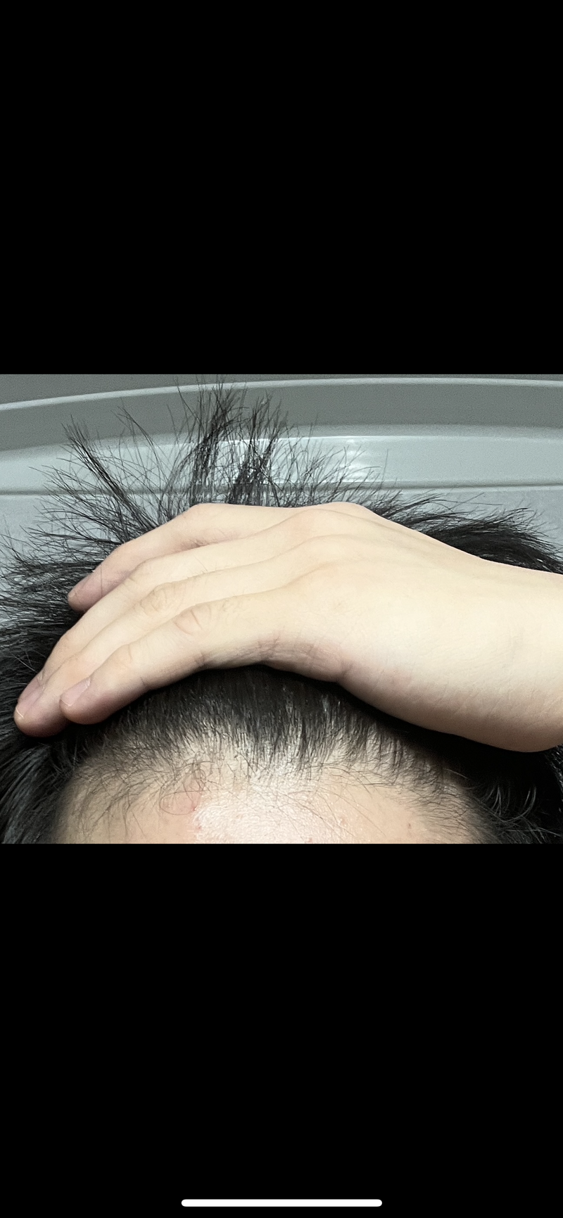 프페 7개월차 효과가 없습니다