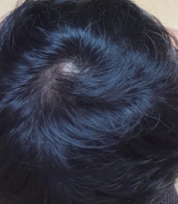 미x페시아및 로x인폼 사용했을때