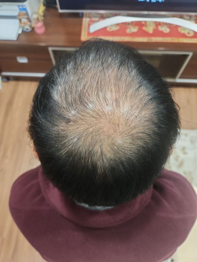 12.2일자에 찍은 2달 사용 후기입니다. 모발량 정말 많아졌어요