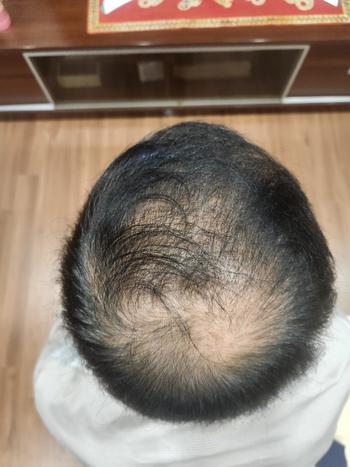 처음 10.8일자에 찍은 사용전 사진입니다. 모발도 많이 얇고 빈 곳이 많아 보였어요.