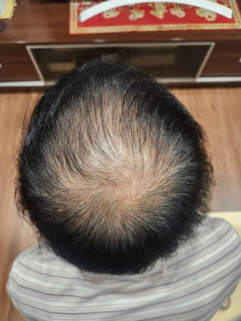 10.18일자 후기 모발이 전보다 굵어짐