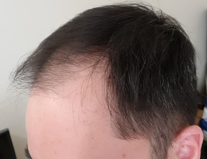 Propecia, Minoxidil 1 Month and Now