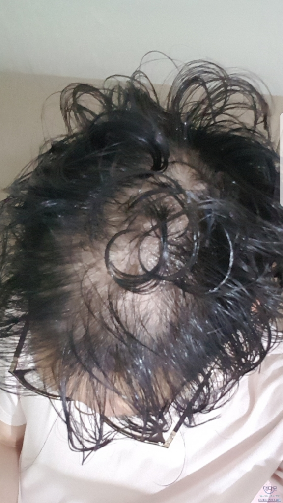 米诺地尔阴影前后的照片