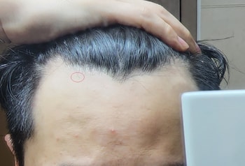 비포(약 3개월 전)