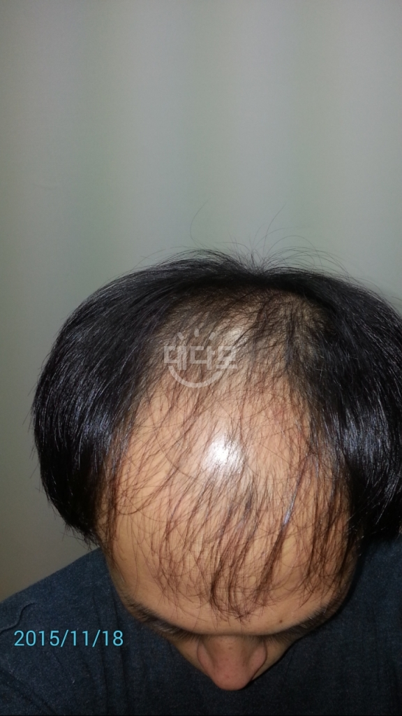 15년11월  약복용시작