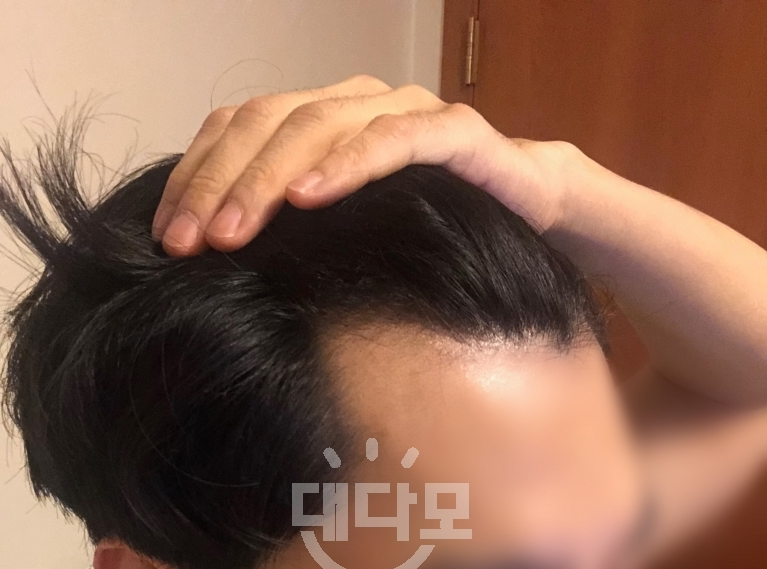 M자 탈모 미녹시딜만 8개월째